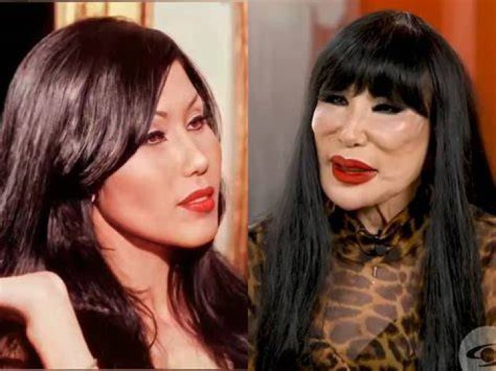 Lyn May Plastic Surgery Let’s Reveal All about It!